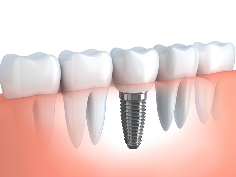 Dental Implants  New Orleans, LA 